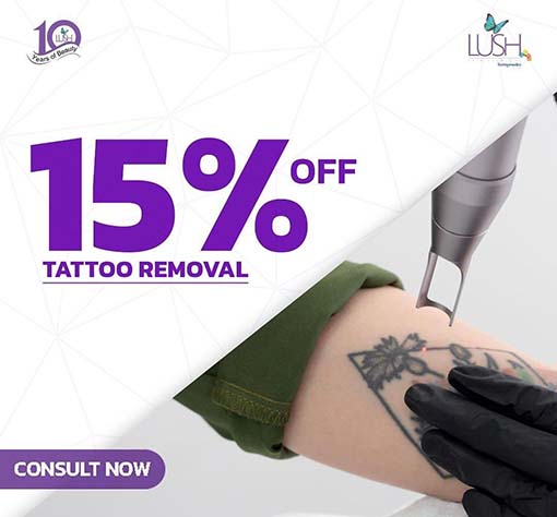 tattoo-removal